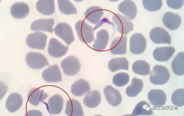 中國又現(xiàn)輸入性非洲錐蟲病病例