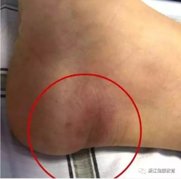 中國又現(xiàn)輸入性非洲錐蟲病病例